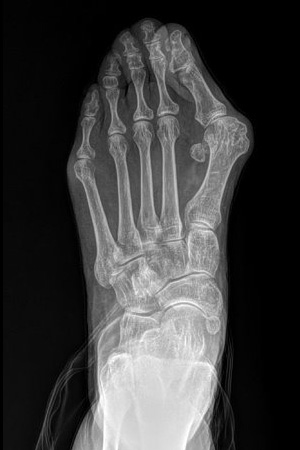 MIS Bunion